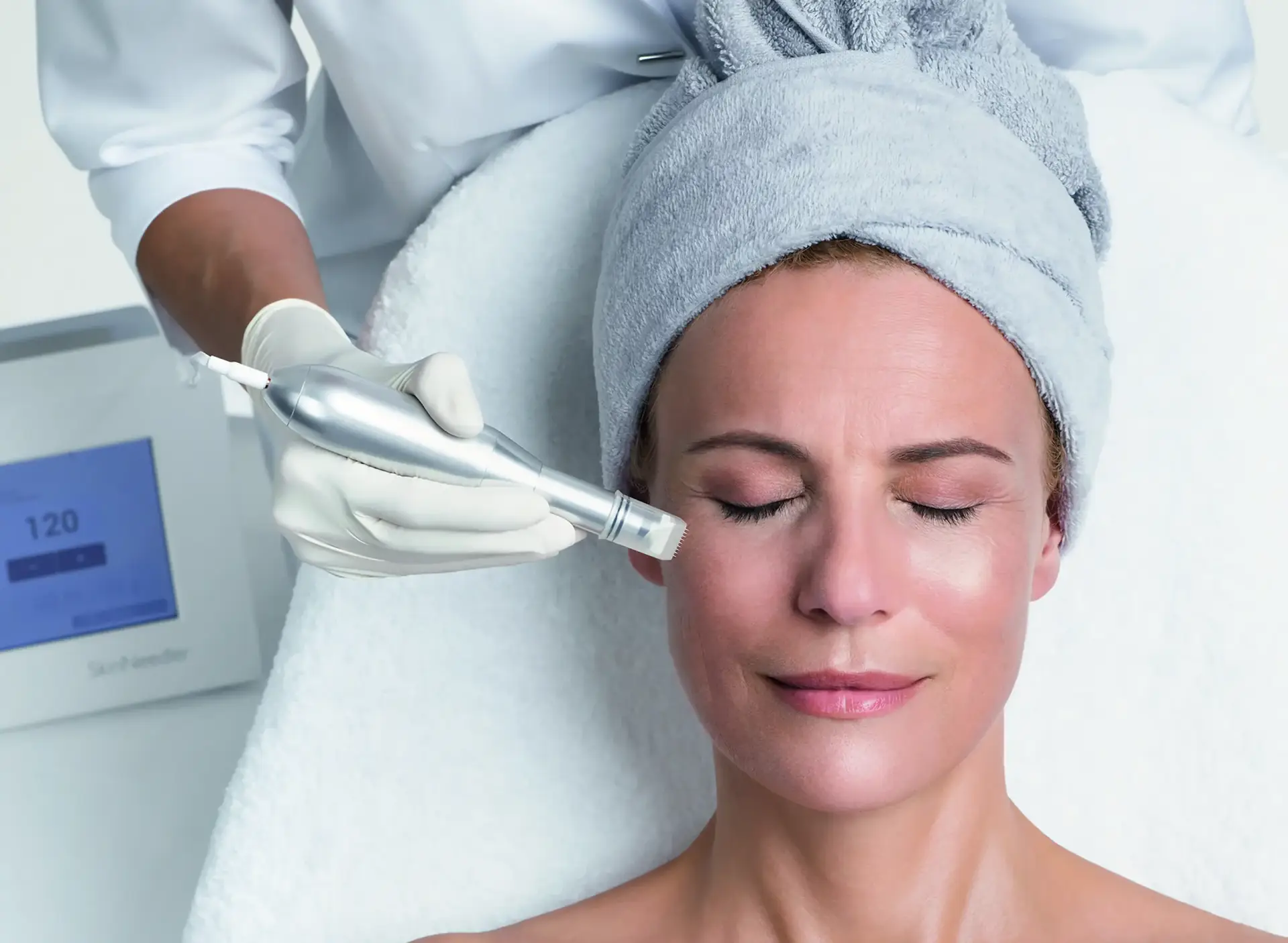 MicroNeedling-Behandlung im Verlauf bei BodyFlair Werdau