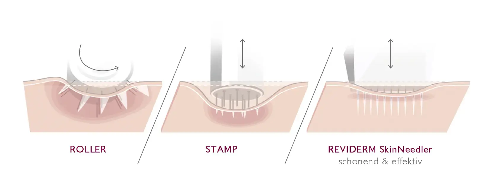 Vergleich der MicroNeedling-Verfahren: Roller und Stamp gegenüber dem REVIDERM SkinNeedler mit Nadeln in einer Reihe