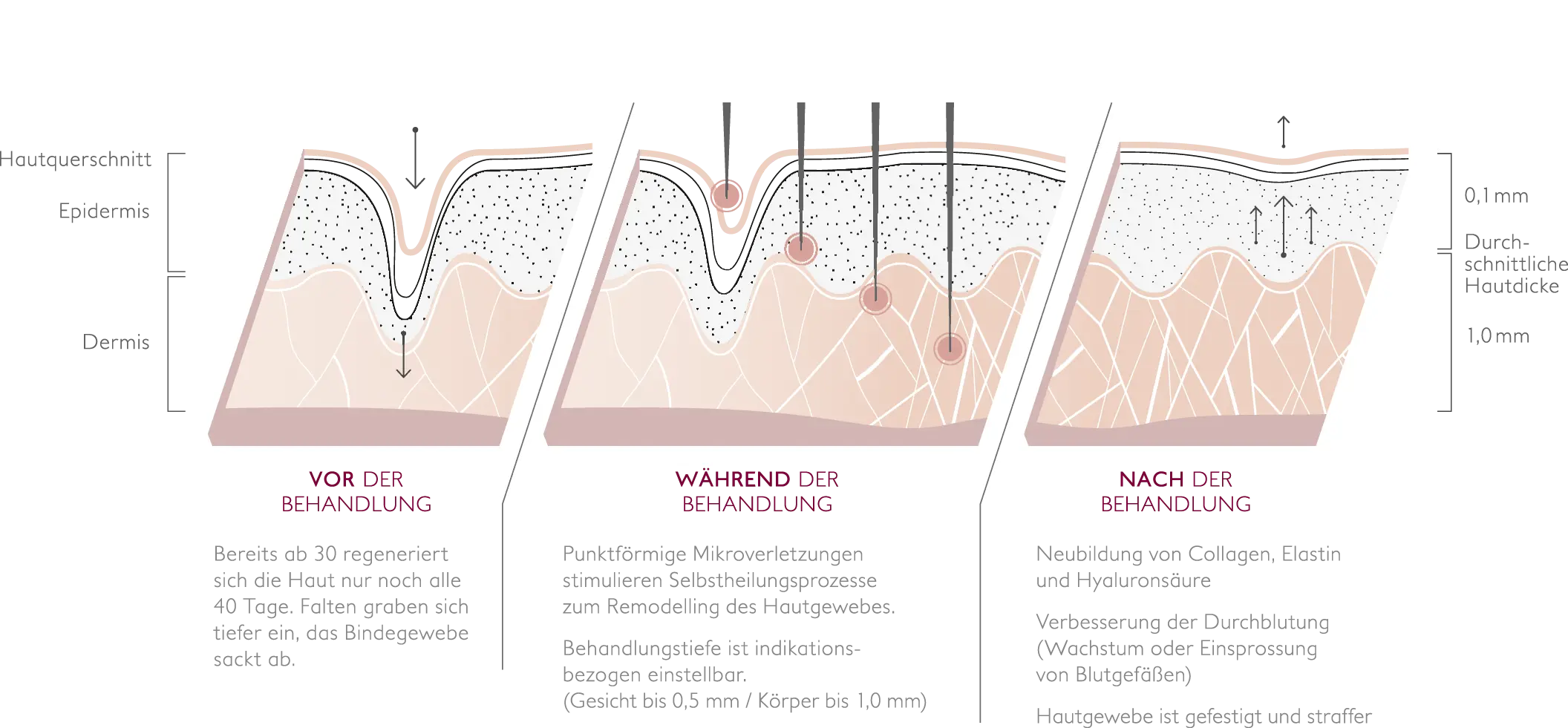 Wirkungsweise MicroNeedling — Infografik: Hautzustand vor, während und nach der Behandlung mit kontrollierten Mikroreizen