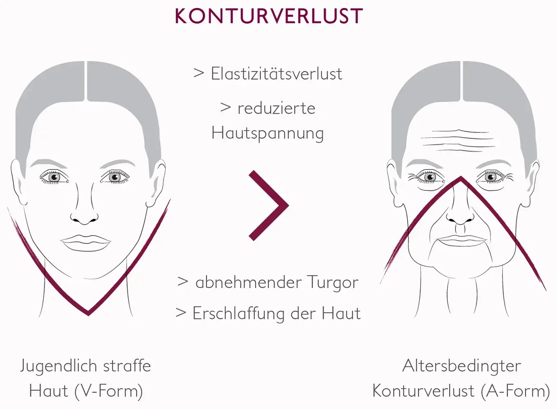 Konturverlust: jugendlich straffe Haut in V-Form gegenüber altersbedingtem Konturverlust in A-Form